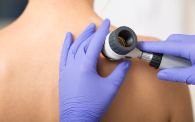 Skin cancer visits to the GP grow