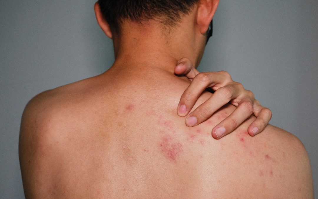 Shingles Awareness Week