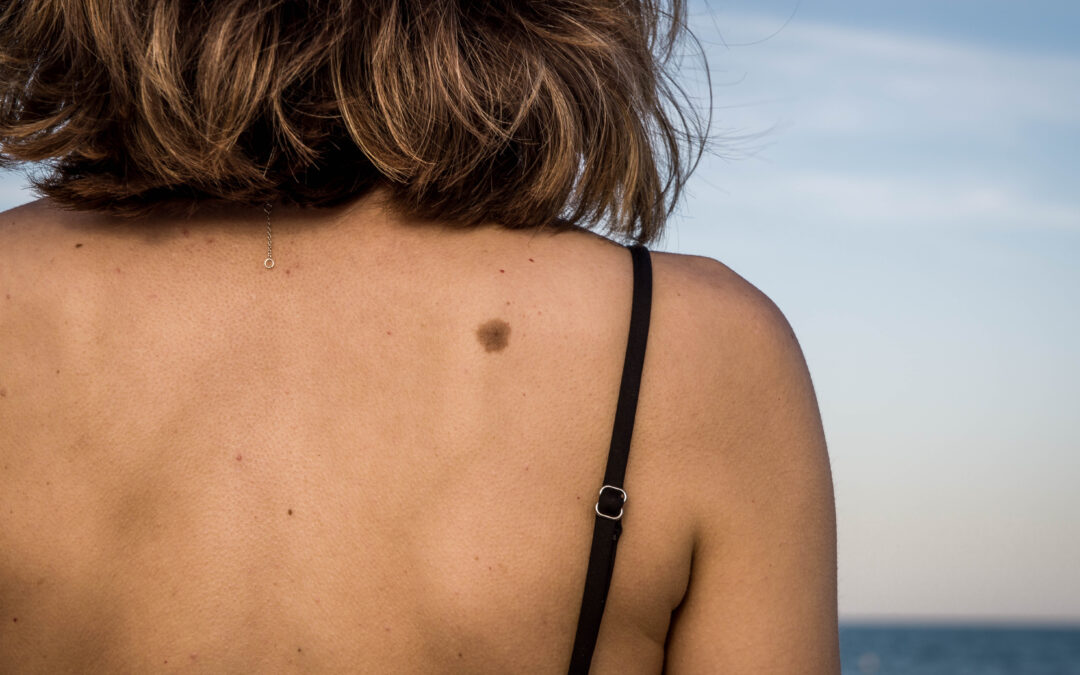 Australians not good at identifying their own melanomas